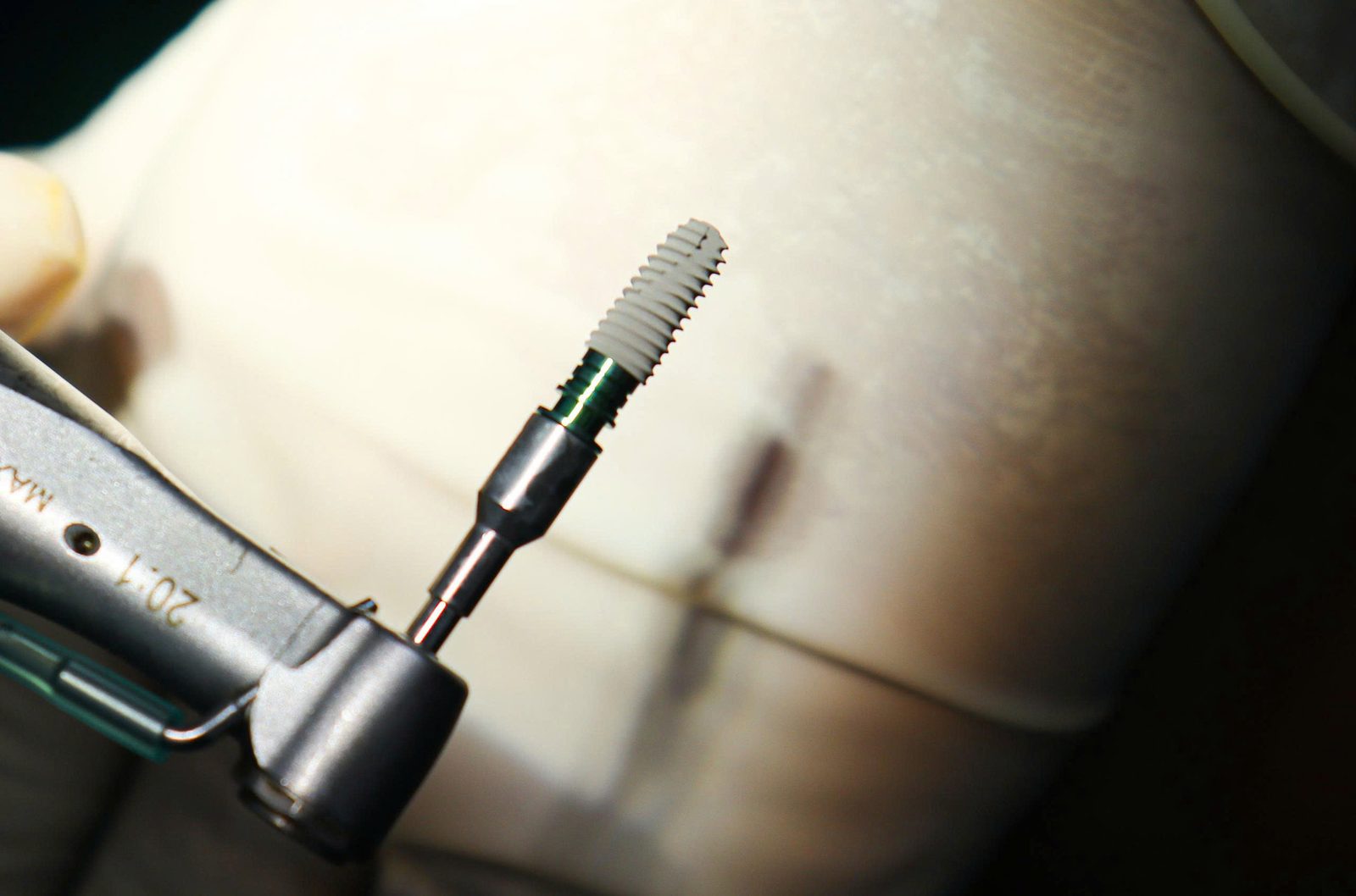 Trụ Implant titan dùng trong cấy ghép Implant tại Nha khoa Thanh Triều
