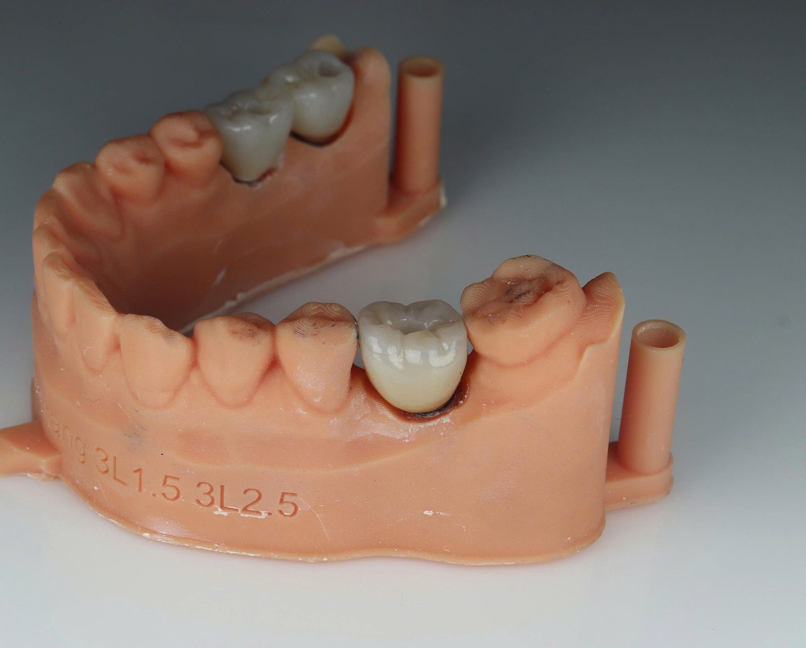 Mô hình răng trên trụ Implant minh họa phục hồi răng đã mất