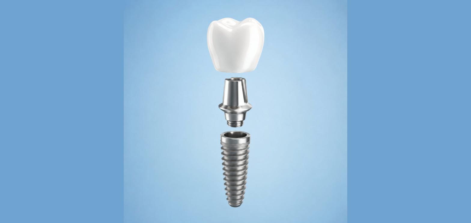 Cấu tạo răng Implant gồm 3 bộ phận: trụ Implant, khớp nối Abutment và mão răng sứ