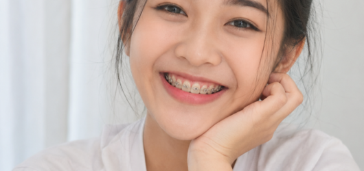 Niềng răng mất bao lâu? Thời gian từng trường hợp