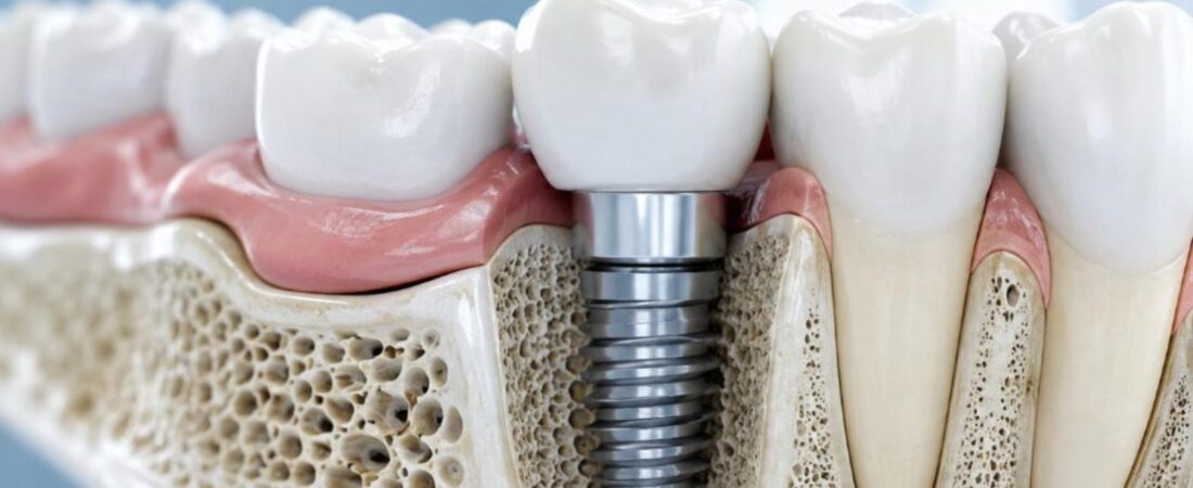 Trồng răng Implant là gì? Những điều bạn nên biết trước khi quyết định