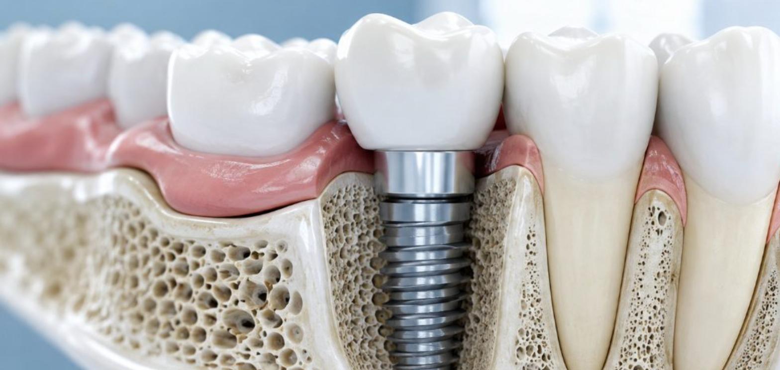 Trồng răng Implant là gì? Những điều bạn nên biết trước khi quyết định