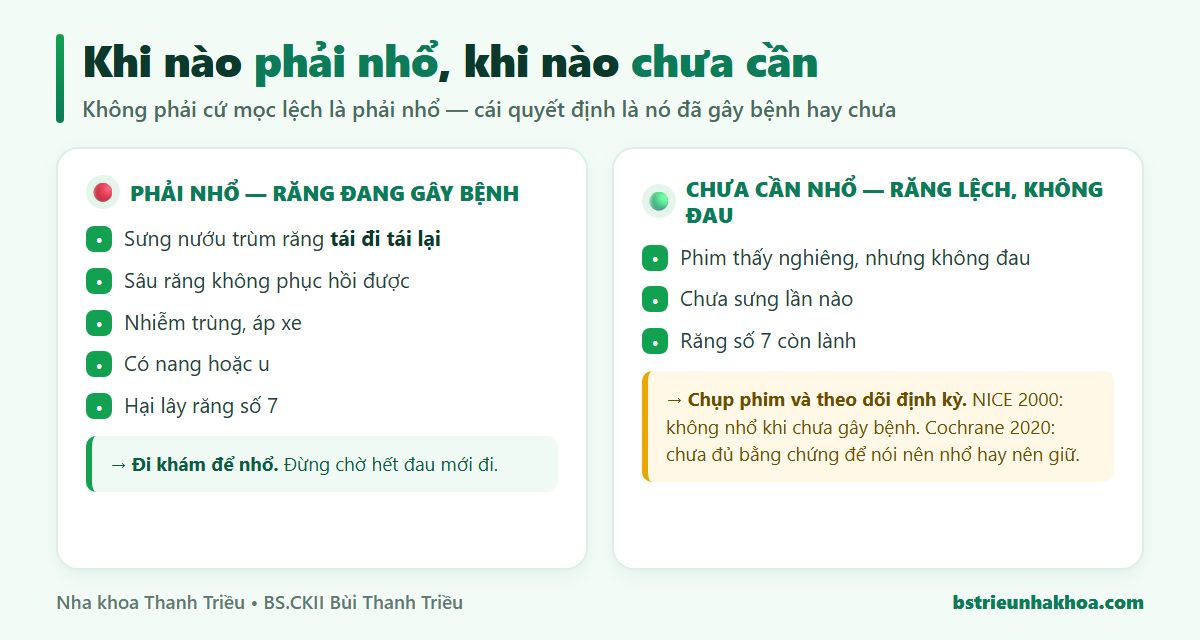 So sánh: răng khôn đang gây bệnh thì cần nhổ, răng khôn mọc lệch không đau thì chưa cần nhổ mà chỉ chụp phim theo dõi