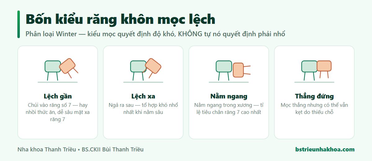 Sơ đồ bốn kiểu răng khôn mọc lệch theo phân loại Winter: lệch gần, lệch xa, nằm ngang, thẳng đứng