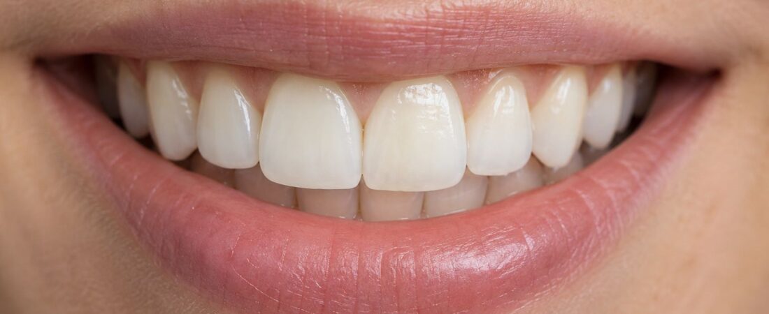 Trám răng thẩm mỹ: khi nào cần và giữ được bao lâu